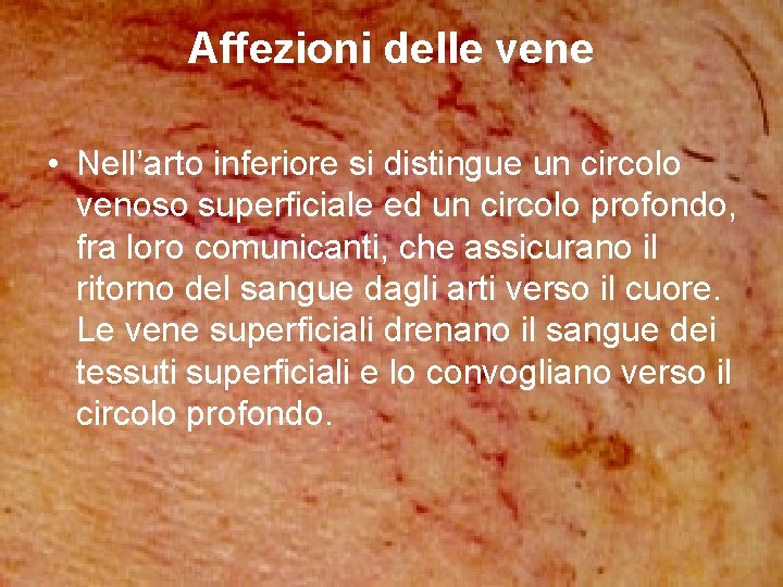 Affezioni delle vene • Nell’arto inferiore si distingue un circolo venoso superficiale ed un