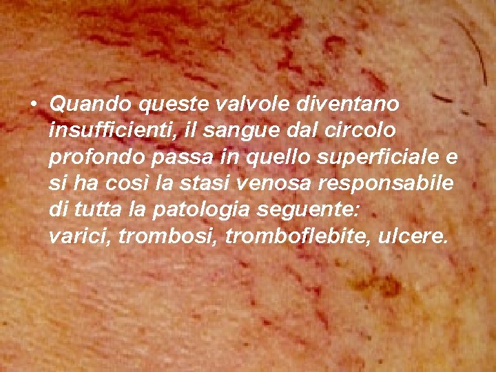 • Quando queste valvole diventano insufficienti, il sangue dal circolo profondo passa in • Quando queste valvole diventano insufficienti, il sangue dal circolo profondo passa in