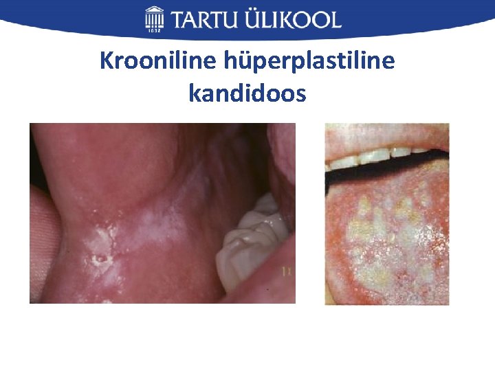 Krooniline hüperplastiline kandidoos 