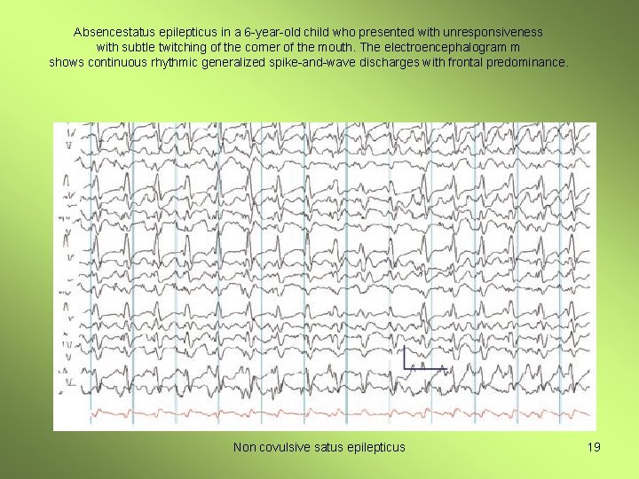 Absencestatus epilepticus in a 6 -year-old child who presented with unresponsiveness with subtle twitching