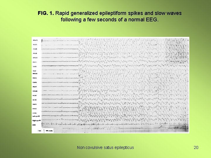 FIG. 1. Rapid generalized epileptiform spikes and slow waves following a few seconds of