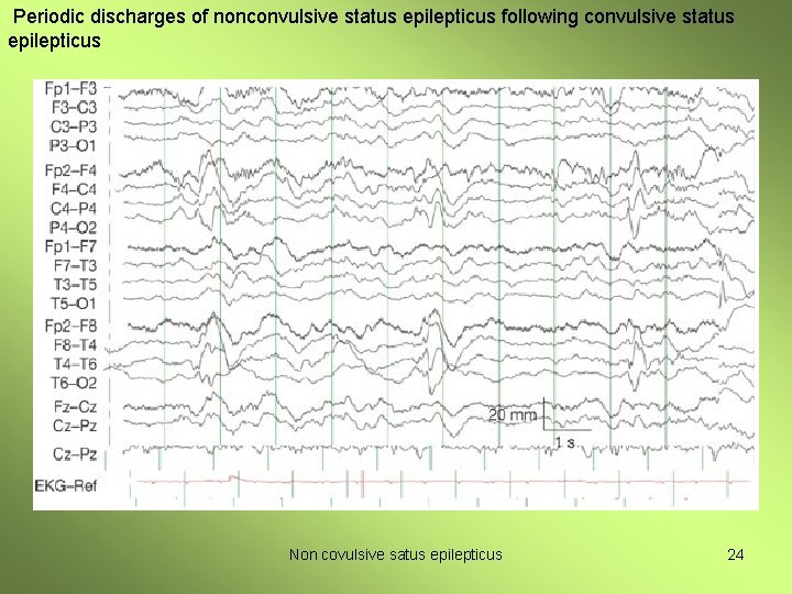 Periodic discharges of nonconvulsive status epilepticus following convulsive status epilepticus Non covulsive satus epilepticus