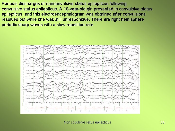 Periodic discharges of nonconvulsive status epilepticus following convulsive status epilepticus. A 10 -year-old girl