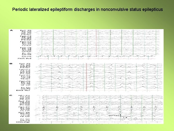 Periodic lateralized epileptiform discharges in nonconvulsive status epilepticus Non covulsive satus epilepticus 26 