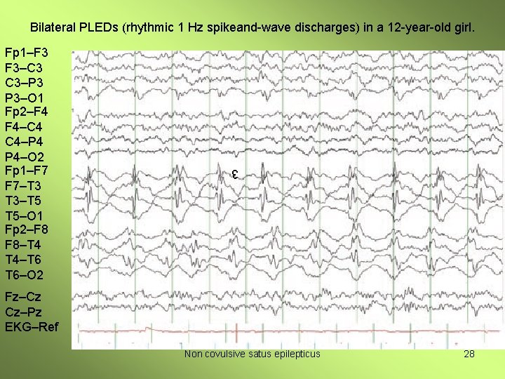 Bilateral PLEDs (rhythmic 1 Hz spikeand-wave discharges) in a 12 -year-old girl. 3 Fp