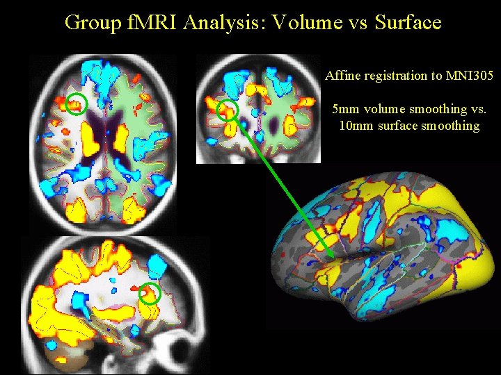 Group f. MRI Analysis: Volume vs Surface Affine registration to MNI 305 5 mm