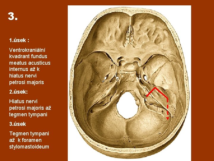 3. 1. úsek : Ventrokraniální kvadrant fundus meatus acusticus internus až k hiatus nervi