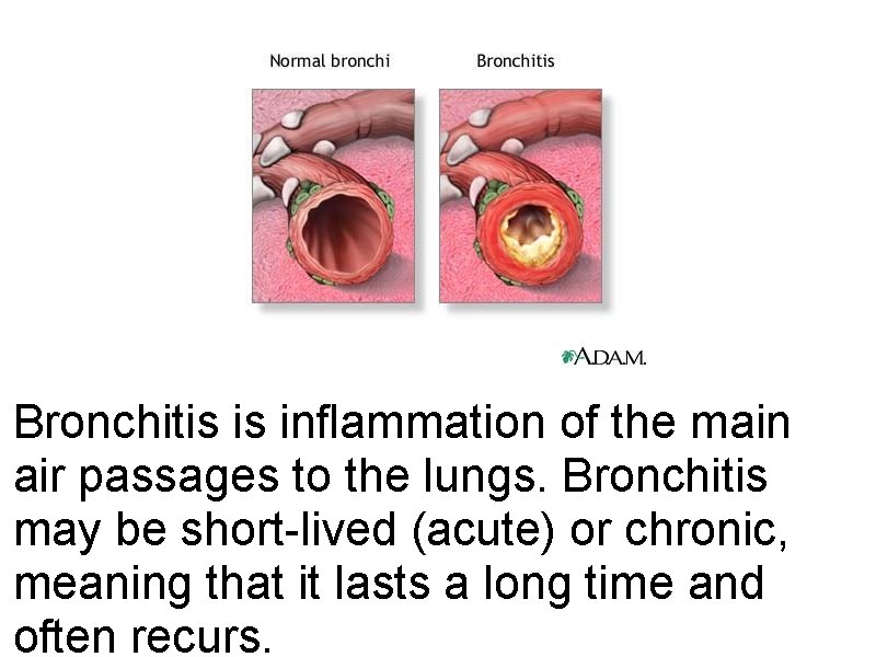 Bronchitis is inflammation of the main air passages to the lungs. Bronchitis may be Bronchitis is inflammation of the main air passages to the lungs. Bronchitis may be