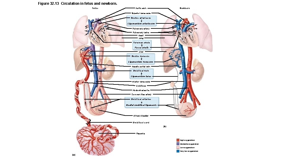 Figure 32. 13 Circulation in fetus and newborn. Fetus Aortic arch Newborn Superior vena