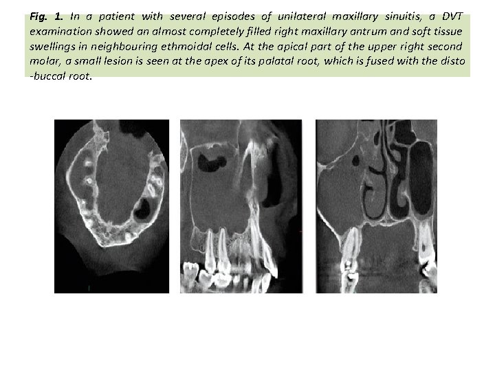Fig. 1. In a patient with several episodes of unilateral maxillary sinuitis, a DVT