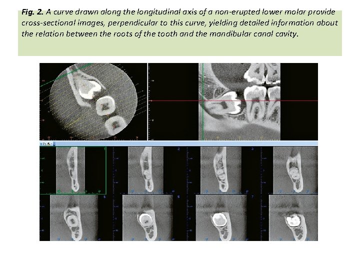Fig. 2. A curve drawn along the longitudinal axis of a non-erupted lower molar