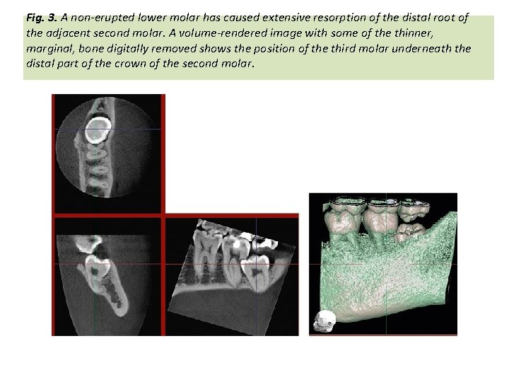 Fig. 3. A non-erupted lower molar has caused extensive resorption of the distal root