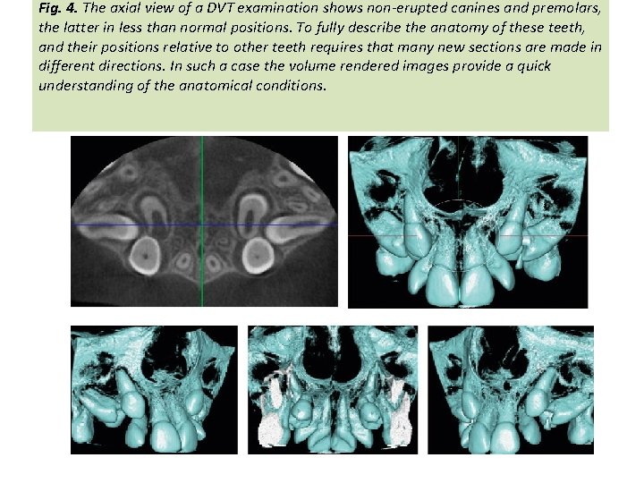 Fig. 4. The axial view of a DVT examination shows non-erupted canines and premolars,
