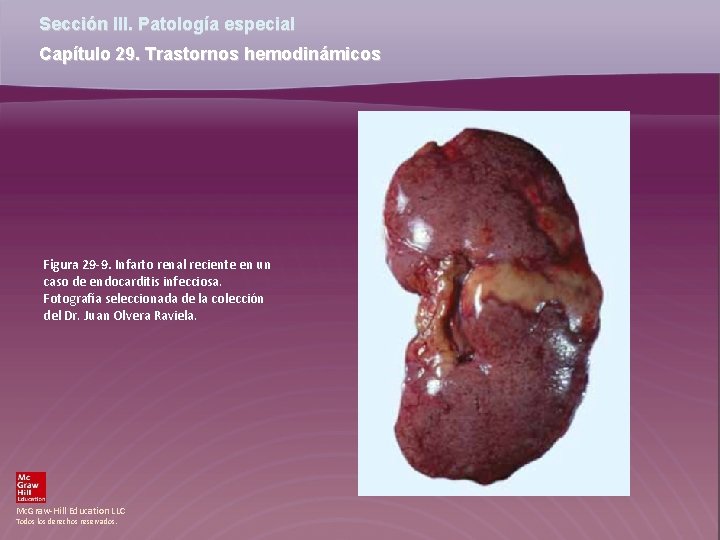 Sección III. Patología especial Capítulo 29. Trastornos hemodinámicos Figura 29 -9. Infarto renal reciente Sección III. Patología especial Capítulo 29. Trastornos hemodinámicos Figura 29 -9. Infarto renal reciente