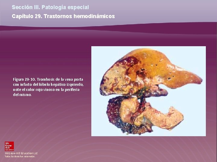 Sección III. Patología especial Capítulo 29. Trastornos hemodinámicos Figura 29 -10. Trombosis de la Sección III. Patología especial Capítulo 29. Trastornos hemodinámicos Figura 29 -10. Trombosis de la