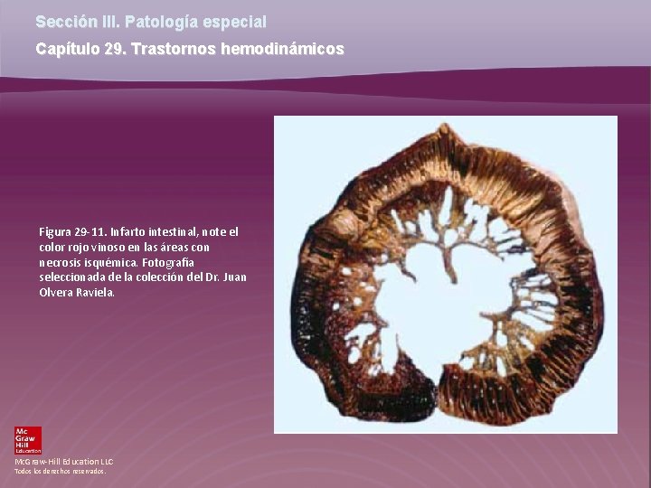 Sección III. Patología especial Capítulo 29. Trastornos hemodinámicos Figura 29 -11. Infarto intestinal, note Sección III. Patología especial Capítulo 29. Trastornos hemodinámicos Figura 29 -11. Infarto intestinal, note