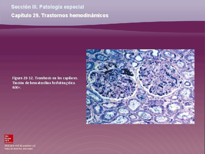 Sección III. Patología especial Capítulo 29. Trastornos hemodinámicos Figura 29 -12. Trombosis en los Sección III. Patología especial Capítulo 29. Trastornos hemodinámicos Figura 29 -12. Trombosis en los