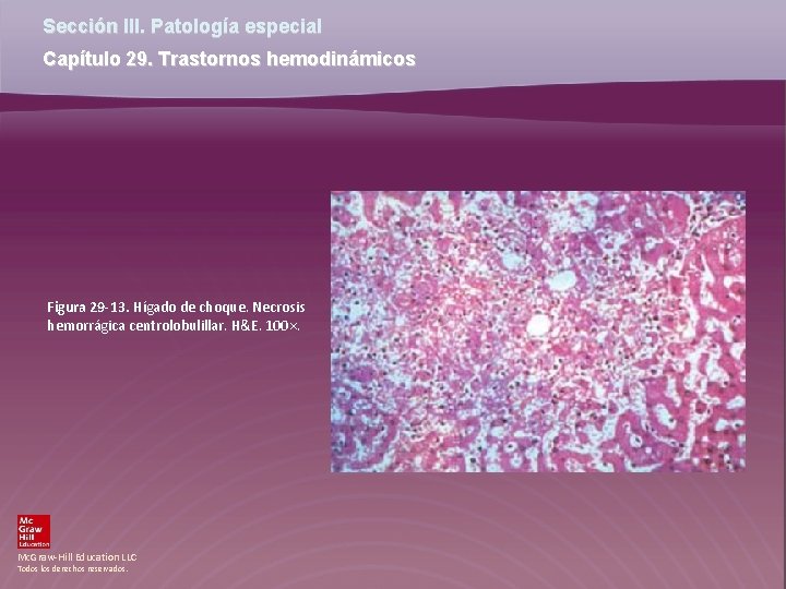Sección III. Patología especial Capítulo 29. Trastornos hemodinámicos Figura 29 -13. Hígado de choque. Sección III. Patología especial Capítulo 29. Trastornos hemodinámicos Figura 29 -13. Hígado de choque.