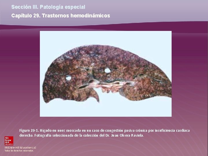 Sección III. Patología especial Capítulo 29. Trastornos hemodinámicos Figura 29 -1. Hígado en nuez Sección III. Patología especial Capítulo 29. Trastornos hemodinámicos Figura 29 -1. Hígado en nuez