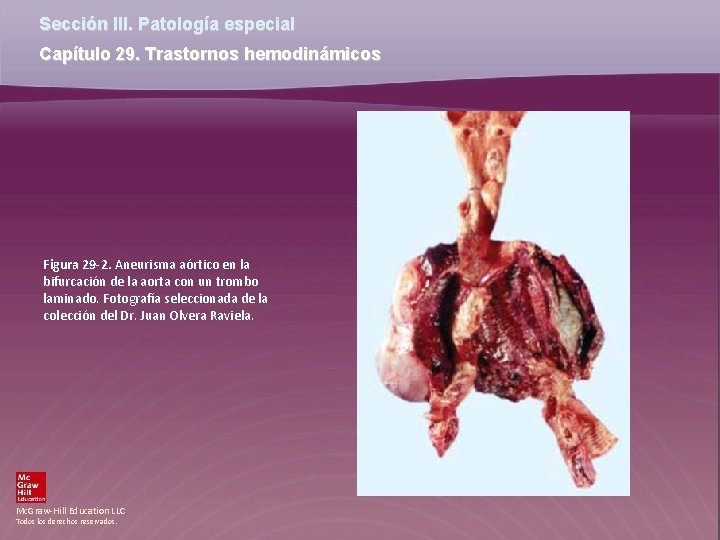 Sección III. Patología especial Capítulo 29. Trastornos hemodinámicos Figura 29 -2. Aneurisma aórtico en Sección III. Patología especial Capítulo 29. Trastornos hemodinámicos Figura 29 -2. Aneurisma aórtico en