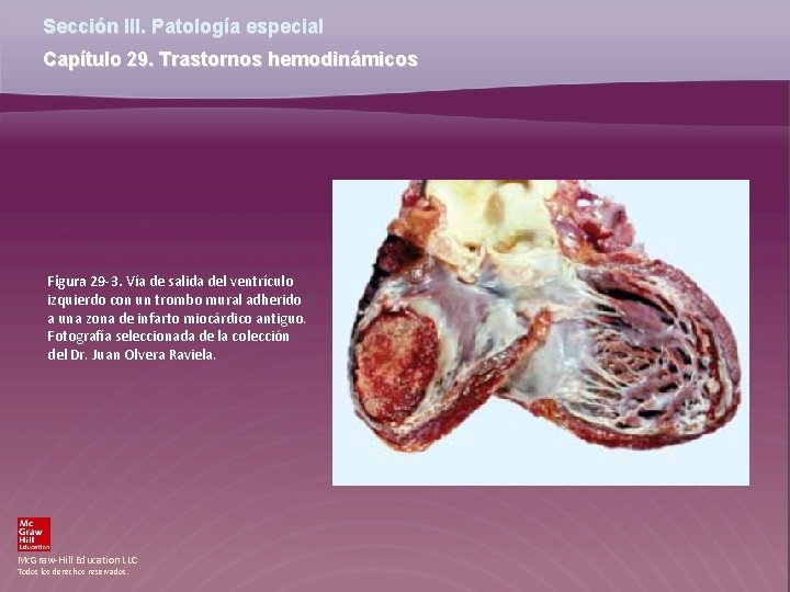 Sección III. Patología especial Capítulo 29. Trastornos hemodinámicos Figura 29 -3. Vía de salida Sección III. Patología especial Capítulo 29. Trastornos hemodinámicos Figura 29 -3. Vía de salida
