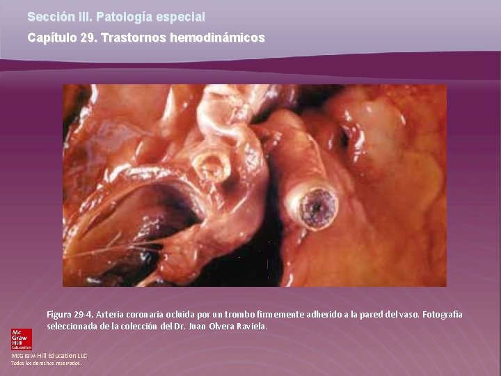 Sección III. Patología especial Capítulo 29. Trastornos hemodinámicos Figura 29 -4. Arteria coronaria ocluida Sección III. Patología especial Capítulo 29. Trastornos hemodinámicos Figura 29 -4. Arteria coronaria ocluida