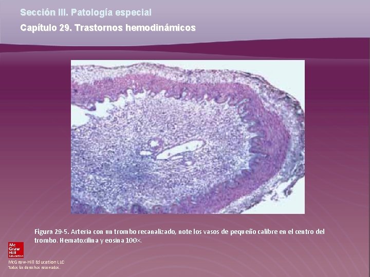 Sección III. Patología especial Capítulo 29. Trastornos hemodinámicos Figura 29 -5. Arteria con un Sección III. Patología especial Capítulo 29. Trastornos hemodinámicos Figura 29 -5. Arteria con un