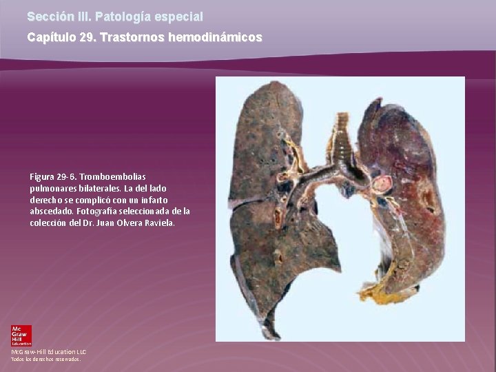 Sección III. Patología especial Capítulo 29. Trastornos hemodinámicos Figura 29 -6. Tromboembolias pulmonares bilaterales. Sección III. Patología especial Capítulo 29. Trastornos hemodinámicos Figura 29 -6. Tromboembolias pulmonares bilaterales.