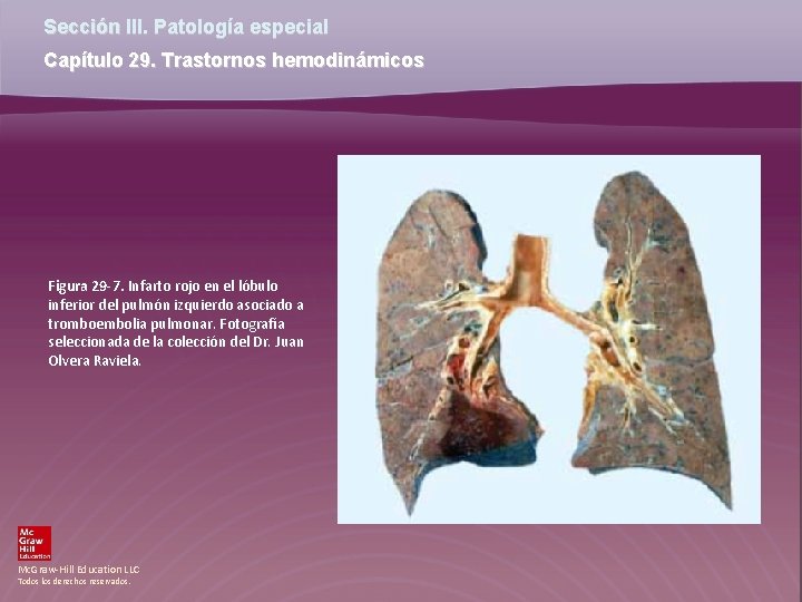 Sección III. Patología especial Capítulo 29. Trastornos hemodinámicos Figura 29 -7. Infarto rojo en Sección III. Patología especial Capítulo 29. Trastornos hemodinámicos Figura 29 -7. Infarto rojo en