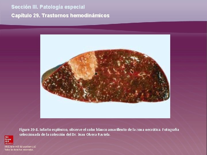 Sección III. Patología especial Capítulo 29. Trastornos hemodinámicos Figura 29 -8. Infarto esplénico, observe Sección III. Patología especial Capítulo 29. Trastornos hemodinámicos Figura 29 -8. Infarto esplénico, observe