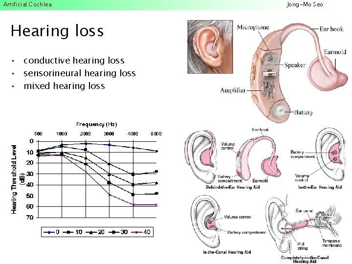 Artificial Cochlea Hearing loss • conductive hearing loss • sensorineural hearing loss • mixed