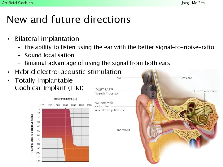 Artificial Cochlea Jong-Mo Seo New and future directions • Bilateral implantation – the ability