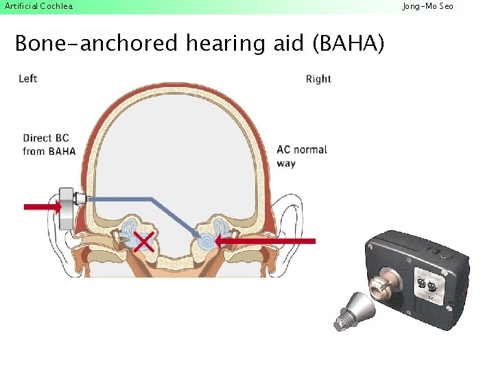 Artificial Cochlea Bone-anchored hearing aid (BAHA) Jong-Mo Seo 