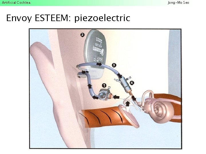 Artificial Cochlea Envoy ESTEEM: piezoelectric Jong-Mo Seo 