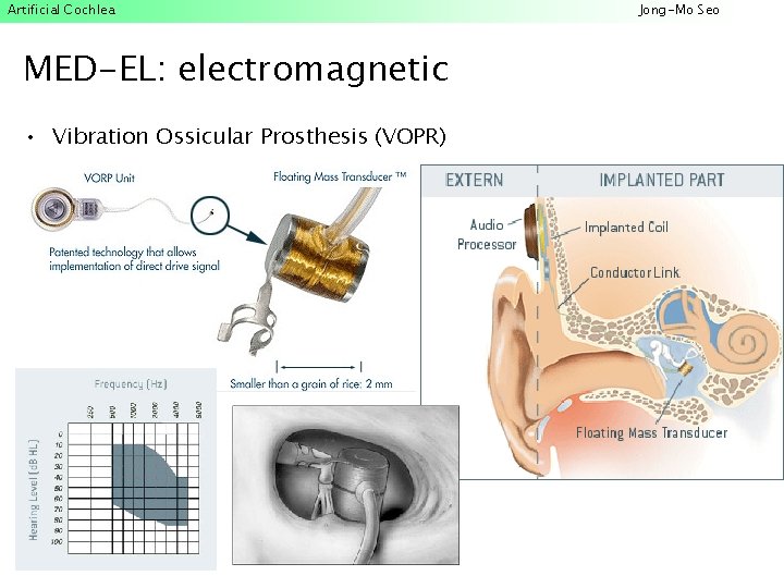 Artificial Cochlea MED-EL: electromagnetic • Vibration Ossicular Prosthesis (VOPR) Jong-Mo Seo 