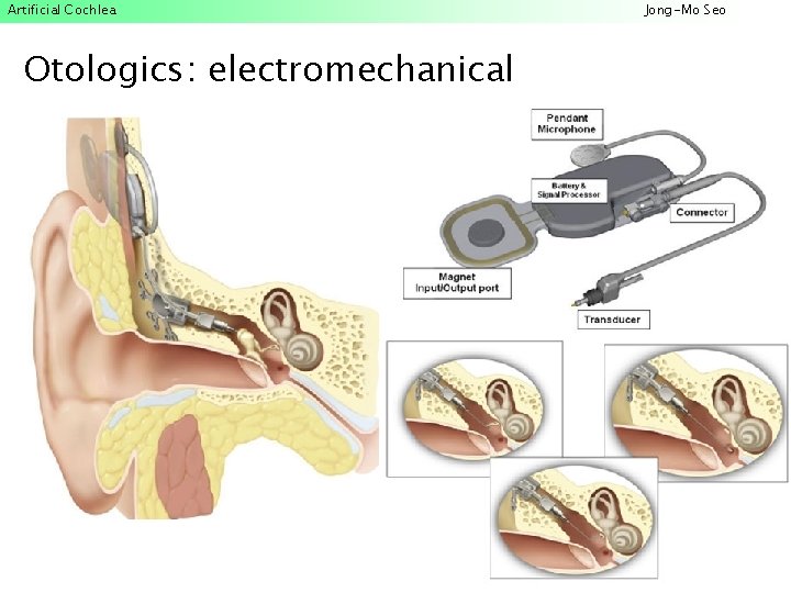 Artificial Cochlea Otologics: electromechanical Jong-Mo Seo 