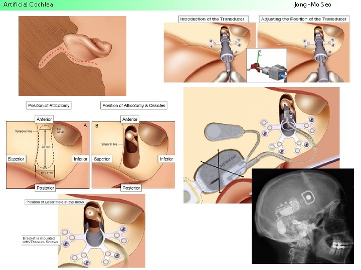 Artificial Cochlea Jong-Mo Seo 