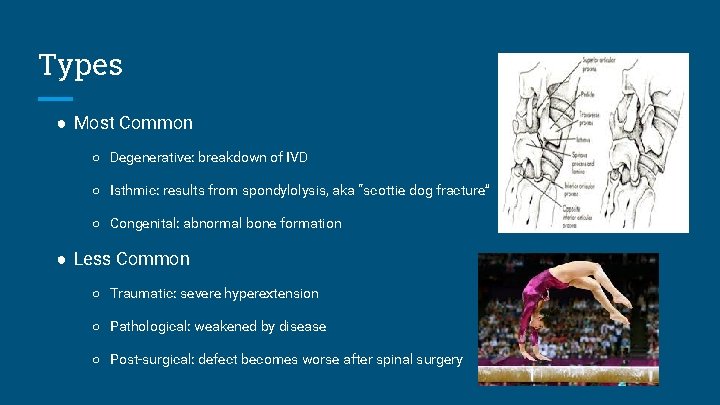 Types ● Most Common ○ Degenerative: breakdown of IVD ○ Isthmic: results from spondylolysis,