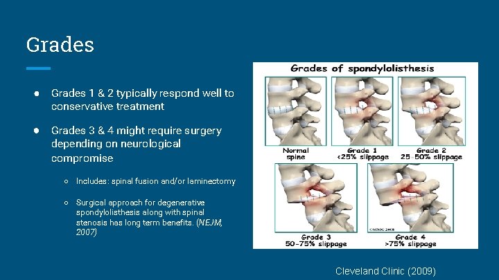 Grades ● Grades 1 & 2 typically respond well to conservative treatment ● Grades