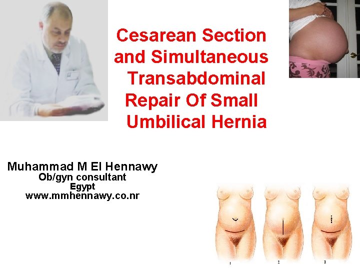 Cesarean Section and Simultaneous Transabdominal Repair Of Small Umbilical Hernia Muhammad M El Hennawy