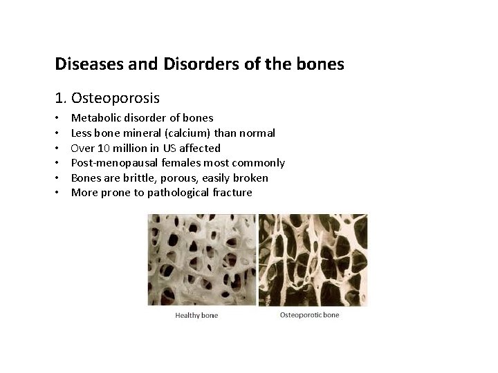 Diseases and Disorders of the bones 1. Osteoporosis • • • Metabolic disorder of