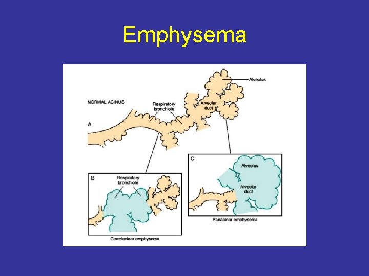 Emphysema 