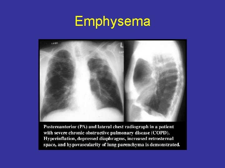 Emphysema 