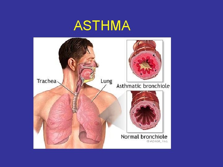 ASTHMA 