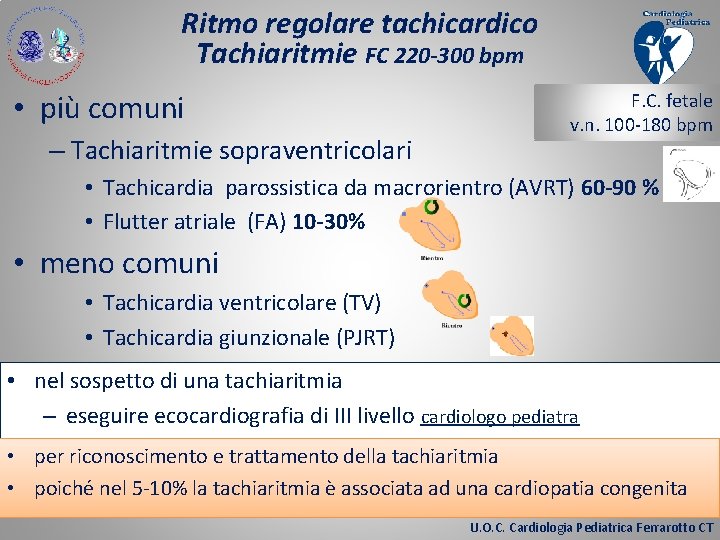 Ritmo regolare tachicardico Tachiaritmie FC 220 -300 bpm • più comuni – Tachiaritmie sopraventricolari