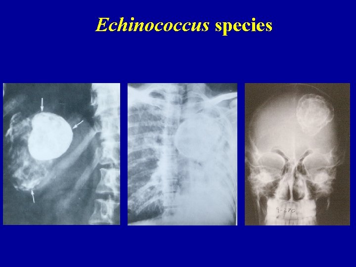 Echinococcus species 