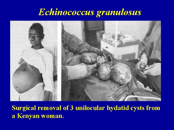 Echinococcus granulosus Surgical removal of 3 unilocular hydatid cysts from a Kenyan woman. 