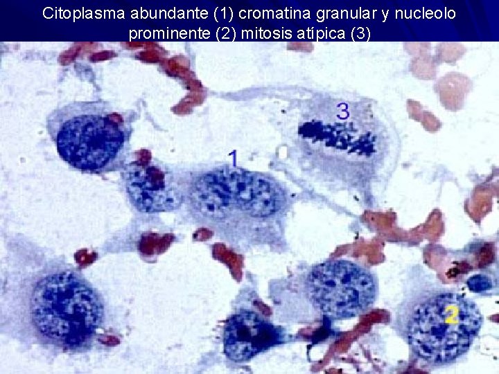 Citoplasma abundante (1) cromatina granular y nucleolo prominente (2) mitosis atípica (3) 