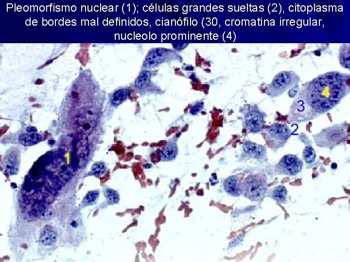 Pleomorfismo nuclear (1); células grandes sueltas (2), citoplasma de bordes mal definidos, cianófilo (30,