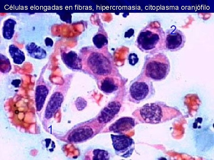 Células elongadas en fibras, hipercromasia, citoplasma oranjófilo 